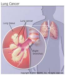 Lung Cancer pic